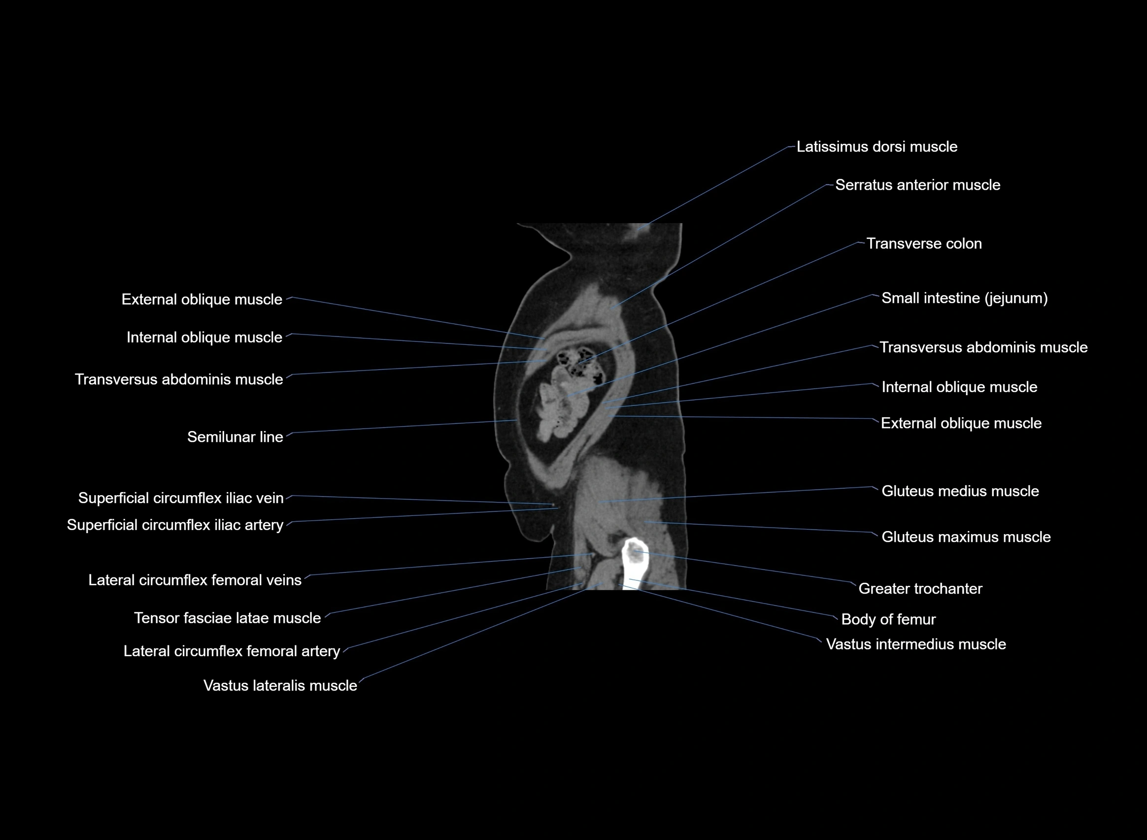 CT Abdomen sagittal cross sectional anatomy labelled radiology image -00012.webp